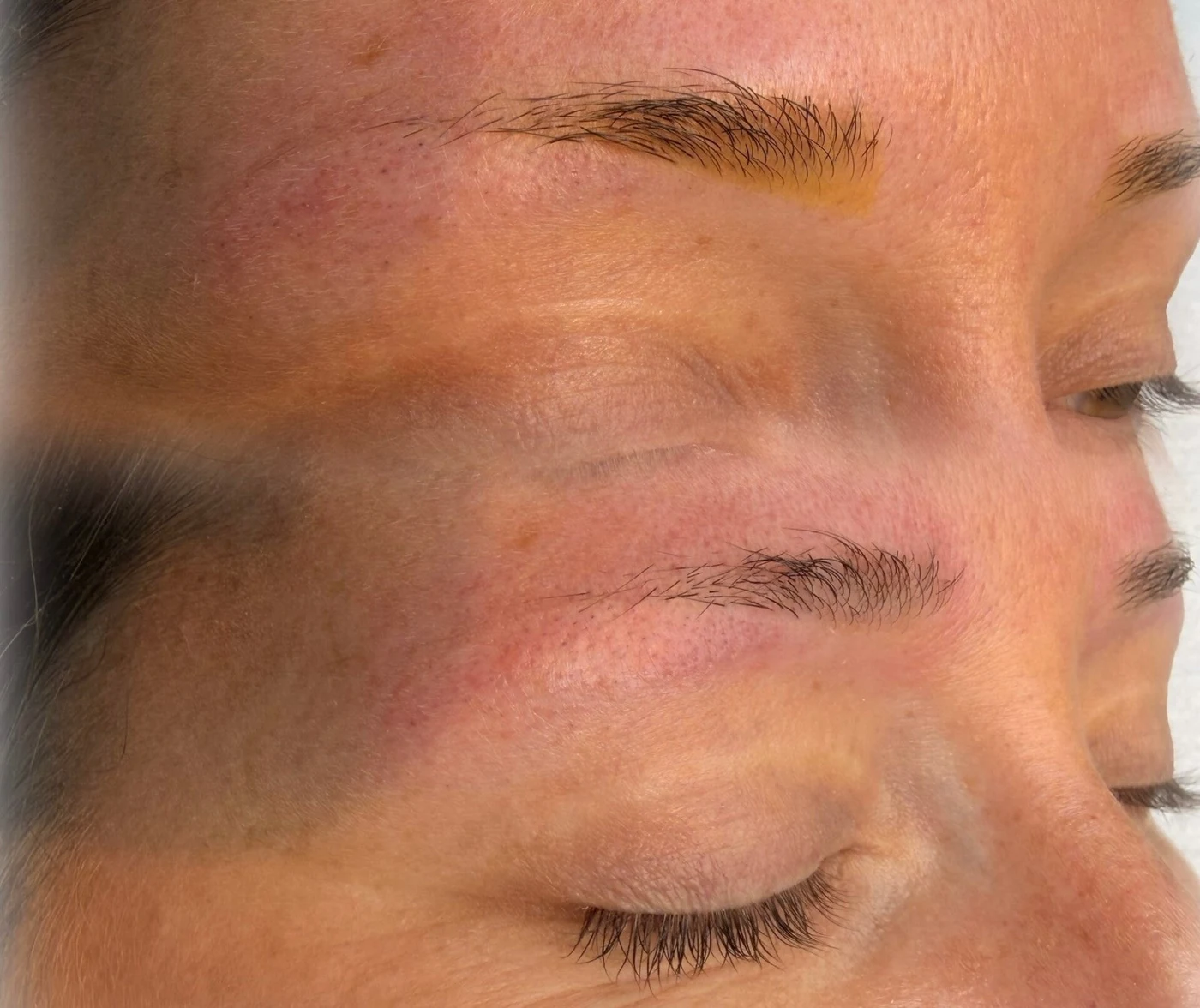 Soft removal behandeling bij By Shay